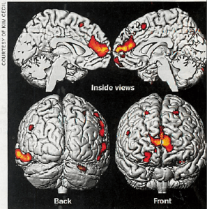 Lead brain damage